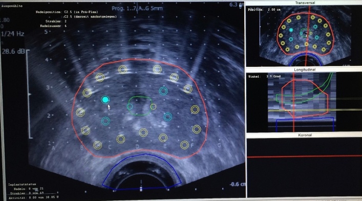 Ultraschallbild auf dem Computer mit geplanten Nadelpositionen und zum Teil bereits gelegten Nadeln (auf dem Bild links und oben) während eines LDR-Eingriffs.
