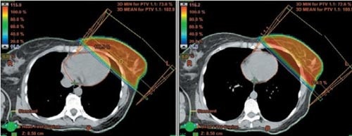 Therapieplan und Dosisverteilung bei der Mamma-Bestrahlung mit tangentialen Feldern. Die Belastung des Herzens (rote Kontur) ist bei Bestrahlung in Atem-Mittellage (links) markant höher als bei Bestrahlung in Inspiration (rechts).