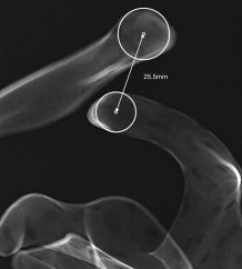 Prof. Dr. med. Matthias A. Zumstein und sein Forschungsteam erhalten den Lipmann-Kessel Preis