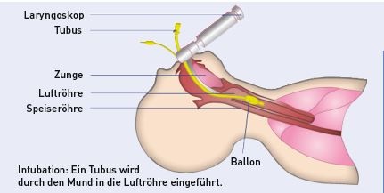 Intubation