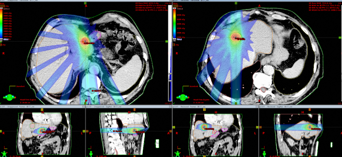 Dosisverteilung für eine stereotaktische Bestrahlung einer Leber-Metastase. Vorteil: Behandlung komplett nicht-invasiv, ambulant, eine Sitzung in weniger als 45 Minuten applizierbar.
